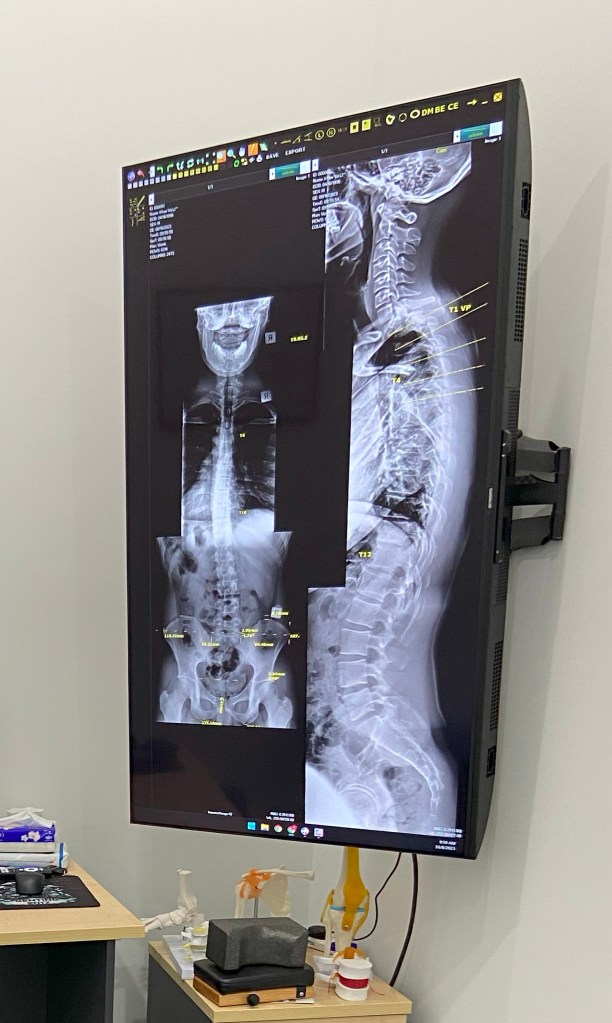 A photograph of an x ray scan, showing the torso and neck.
